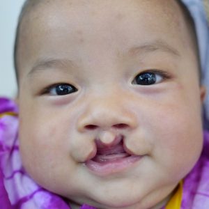 Sponsor a Surgery for One Child