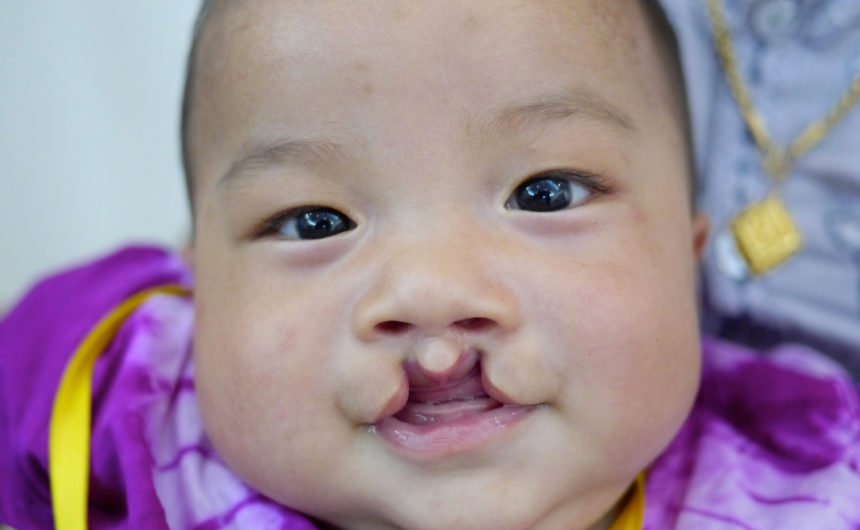 Sponsor a Surgery for One Child