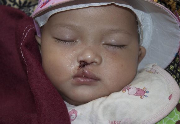 Day Three – Palate Surgeries