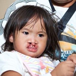 Cleft Lip & Cleft Palate – Manila, Philippines