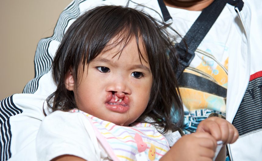 051 Cleft Lip & Cleft Palate – Manila, Philippines