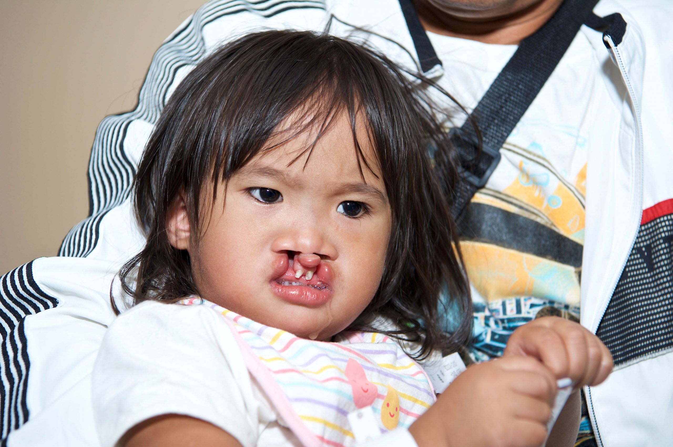 Cleft Lip & Cleft Palate - Manila, Philippines.