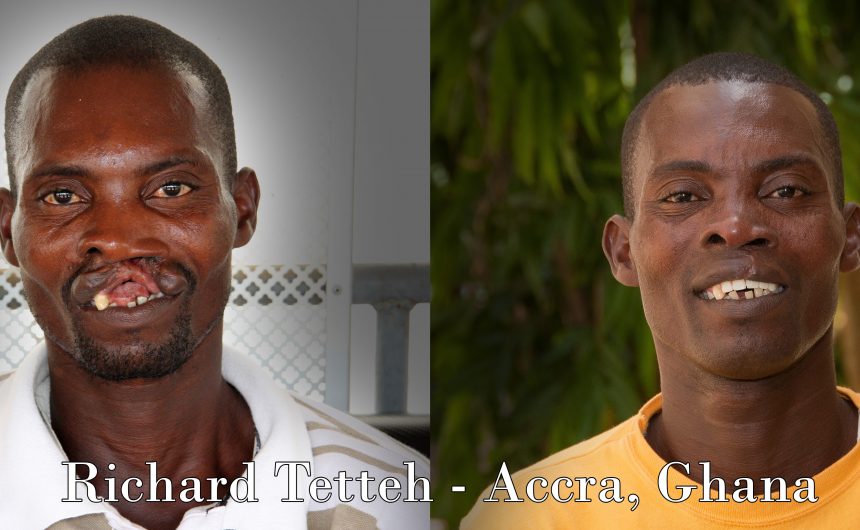 Richard Before and After Photo Slideshow