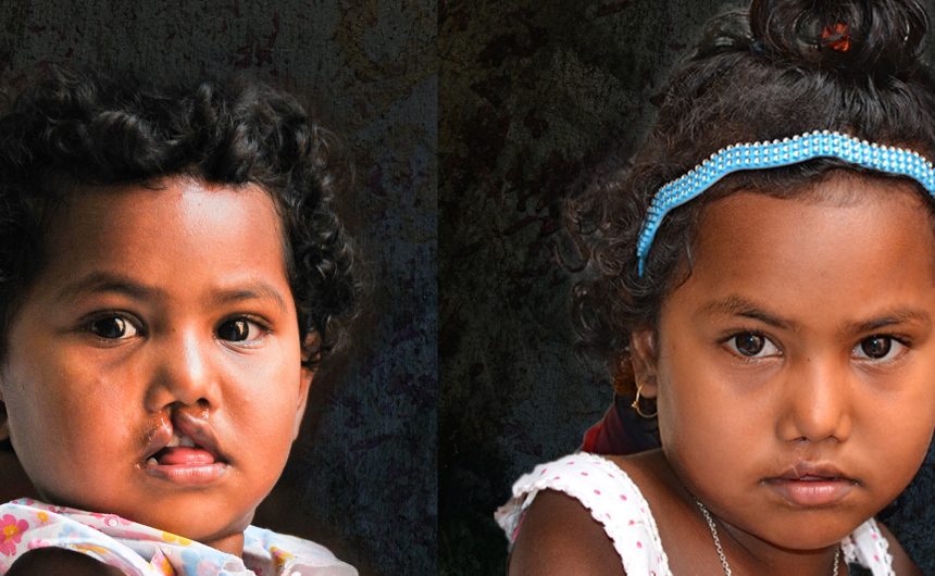 Somiya before and after Before and After Photo Slideshow