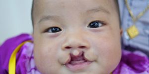 babycleft1500